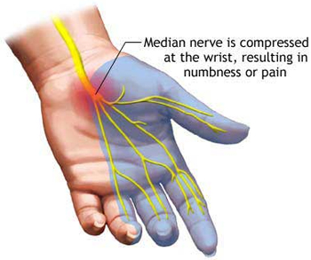 Carpal tunnel syndrome (CTS)