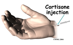 Carpal tunnel syndrome steroid injection
