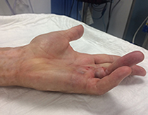 Finger before the straightening procedure