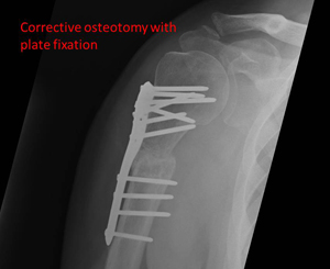 Corrective osteotomy