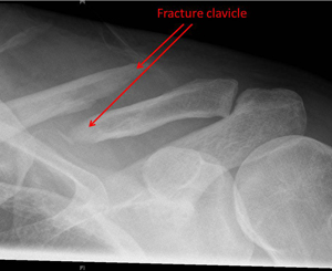 displaced fracture in the middle third of the clavicle