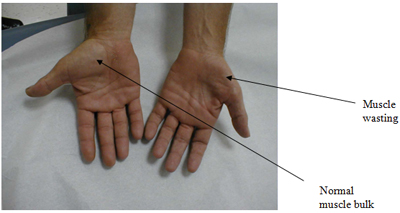 Carpal tunnel syndrome (CTS)