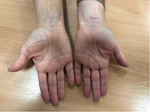 Carpal tunnel syndrome (CTS)