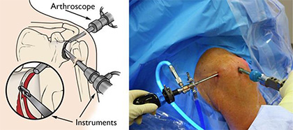 Keyhole Surgery for the Treatment of Dislocating Shoulder