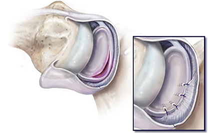 Keyhole Surgery