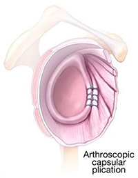 Keyhole Surgery