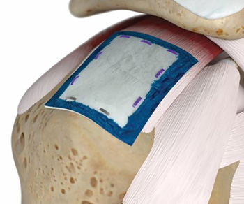 Regeneten Bioinductive Implant