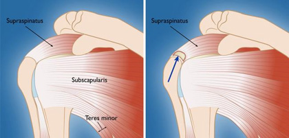 Rotator Cuff Tears