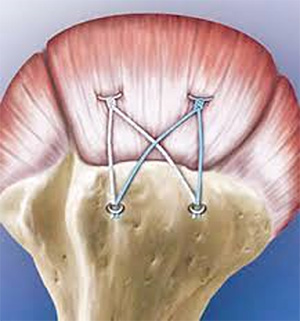 Rotator Cuff Tears