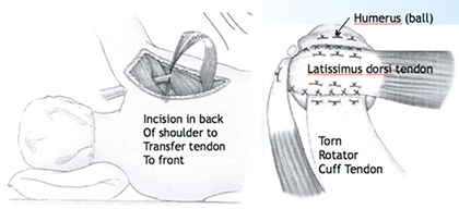 Rotator Cuff Tears