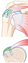 Rotator Cuff Tears