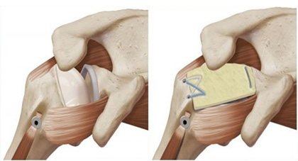 Rotator Cuff Tears