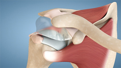 Rotator Cuff Tears