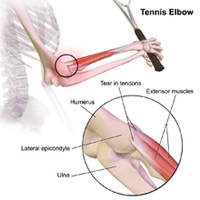 Tennis and Golfer's Elbow