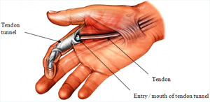 Trigger finger / Trigger thumb