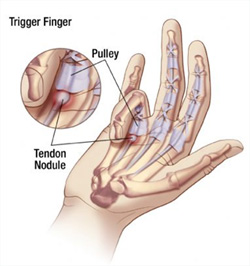 Trigger finger / Trigger thumb
