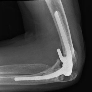 total elbow replacement