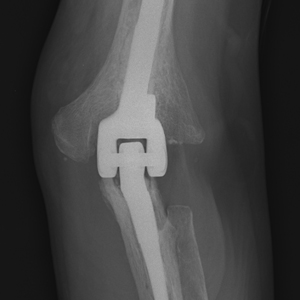 total elbow replacement