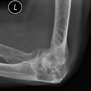 total elbow replacement