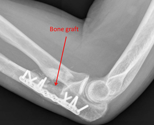 fracture of the ulna