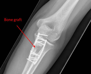 fracture of the ulna