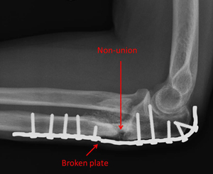 fracture of the ulna