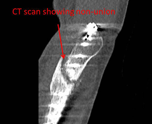 fracture of the ulna