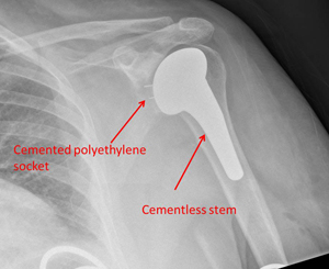 cemented hemiarthroplasty 