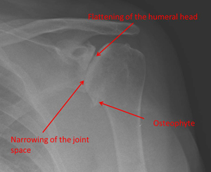 cemented hemiarthroplasty 