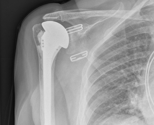 cementless short-stem humerus