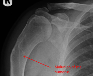 Corrective osteotomy