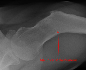 Corrective osteotomy