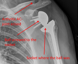 cuff-tear arthropathy