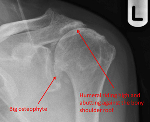 cuff-tear arthropathy