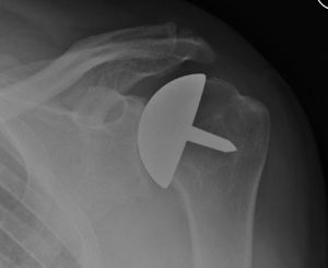 osteoarthritis of the shoulder