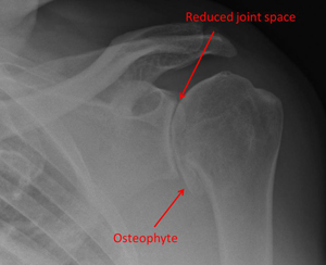 osteoarthritis of the shoulder
