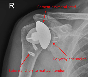 stemless head replacement