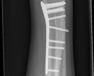 corrective osteotomy