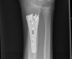 corrective osteotomy