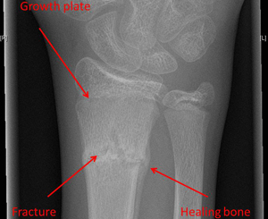 corrective osteotomy