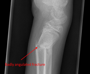 corrective osteotomy