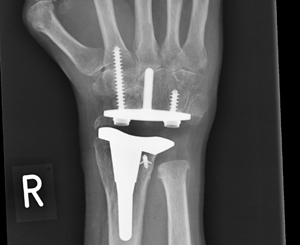 total wrist replacement