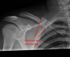 fracture of the collar bone