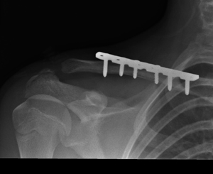 fracture of the collar bone