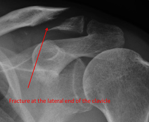 Displaced fracture of the lateral end of the collar bone