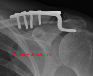 Displaced fracture of the lateral end of the collar bone
