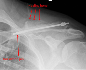 displaced fracture in the middle third of the clavicle