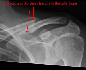 shortened (overlapping ends) fracture of the collar bone