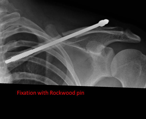 shortened (overlapping ends) fracture of the collar bone