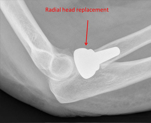 comminuted fracture